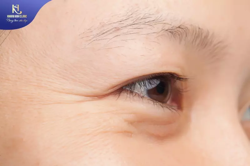 tiêm botox xóa nhăn mắt