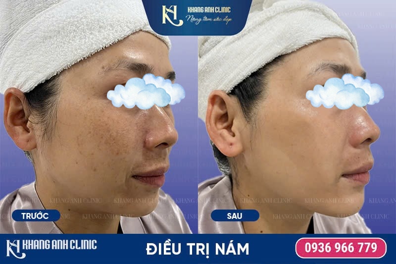 điều trị nám