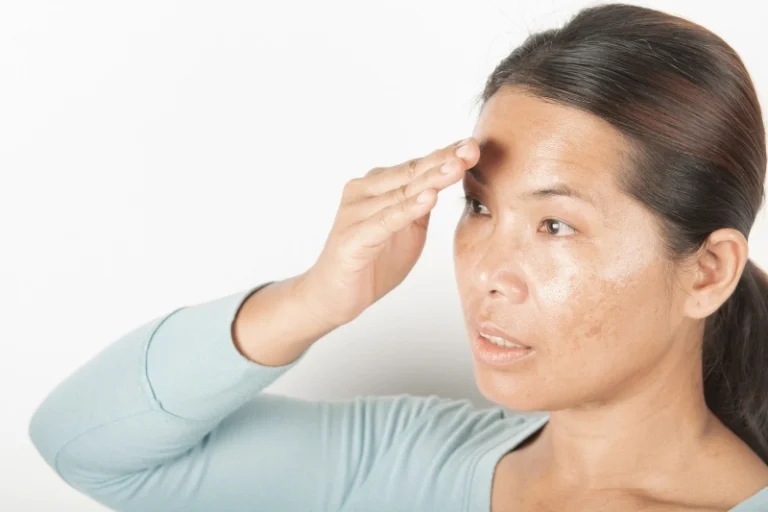 Cách điều trị nám tại nhà - Đơn giản, hiệu quả, không tái phát
