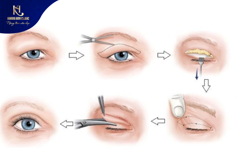 cách tạo mắt 2 mí tự nhiên