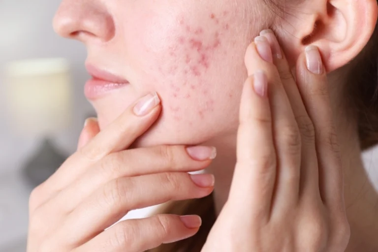 Địa chỉ điều trị mụn TPHCM ở đâu uy tín? Có gần đây không?