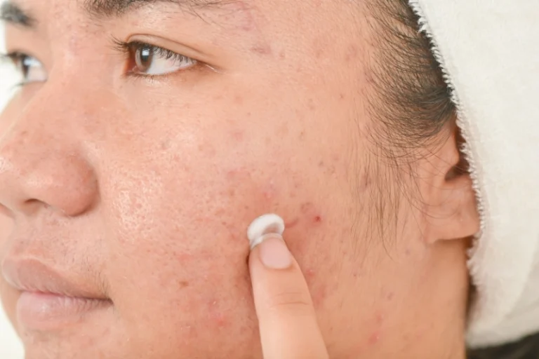 Điều trị mụn giá bao nhiêu? Ở đâu điều trị mụn uy tín Quận 12?