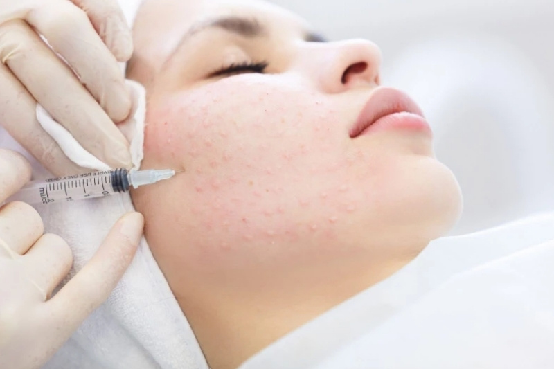 Điều trị nám bằng meso có thực sự hiệu quả không?