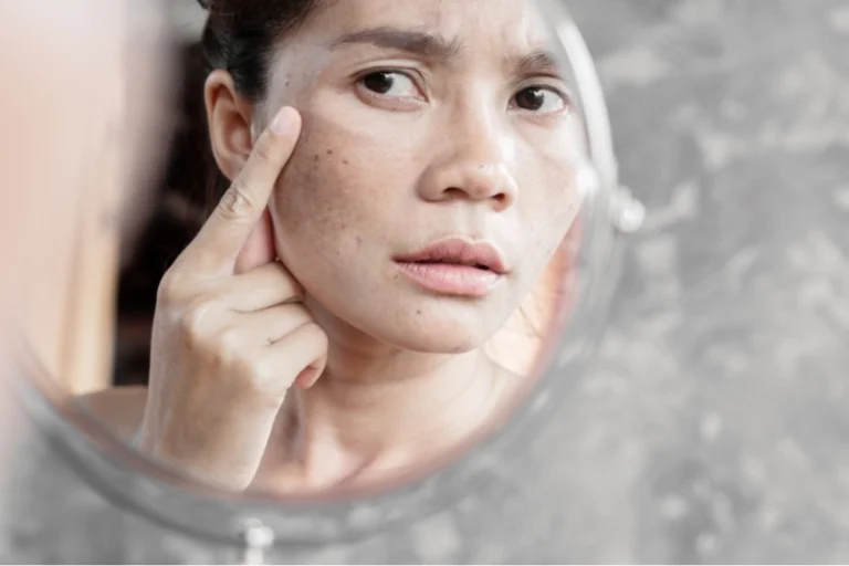 Ai đã điều trị nám thành công chưa? Câu chuyện của 4 khách hàng