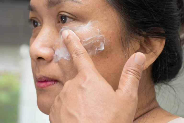 7 Sai lầm trong điều trị nám khiến tình trạng da ngày càng tệ hơn