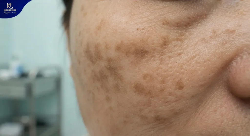tiêm meso trị nám, meso nám, meso tan nám, meso trị nám tốt nhất hiện nay, meso trị nám, các loại meso trị nám