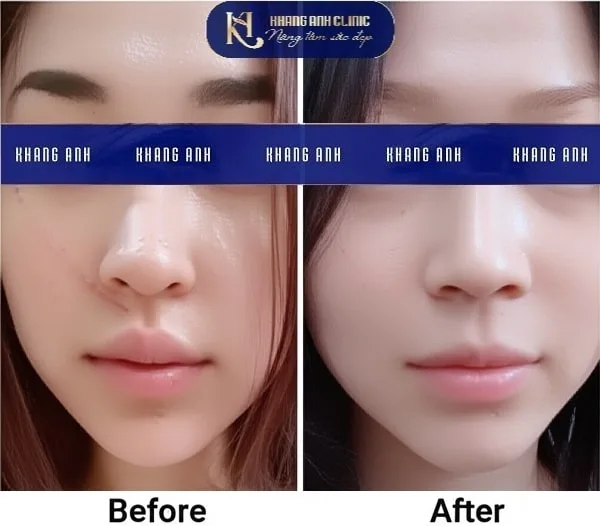 Khách số 1 trước và sau khi trị sẹo lồi