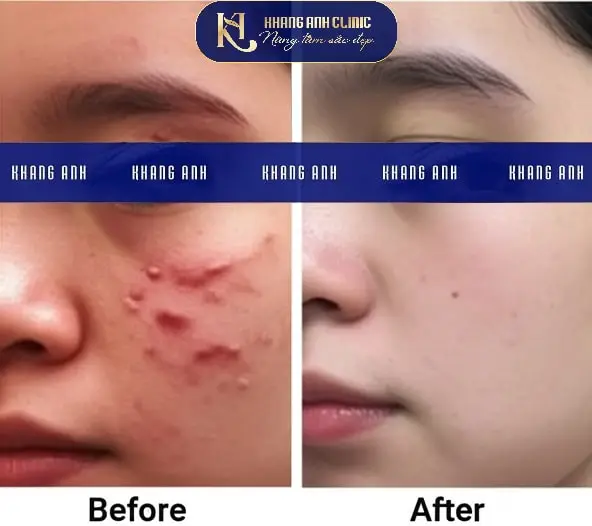 Khách số 2 trước và sau khi trị sẹo lồi