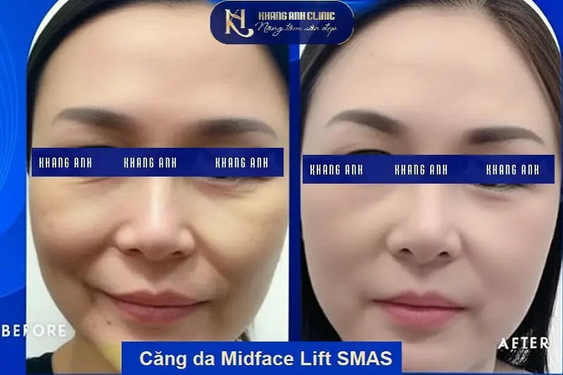 Hiệu quả căng da mặt tầng giữa Midface Lift SMAS