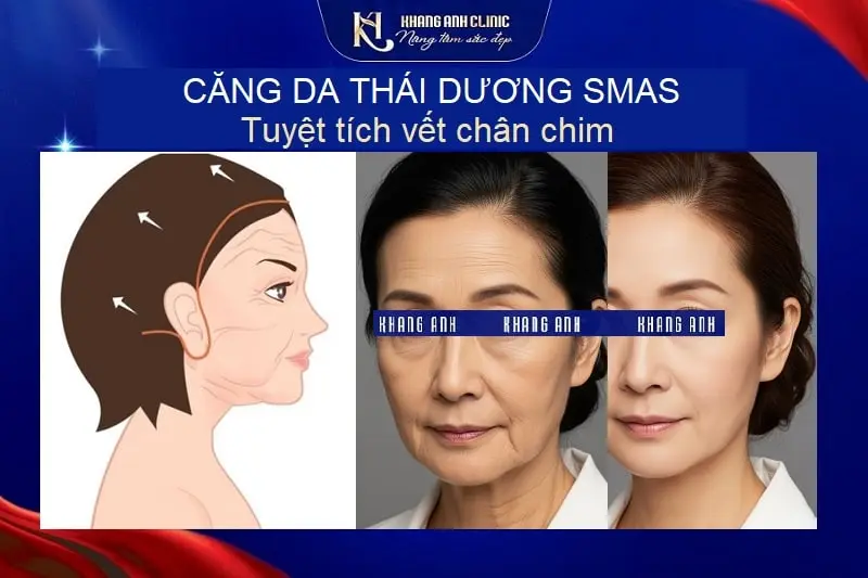 Phương pháp căng da thái dương SMAS