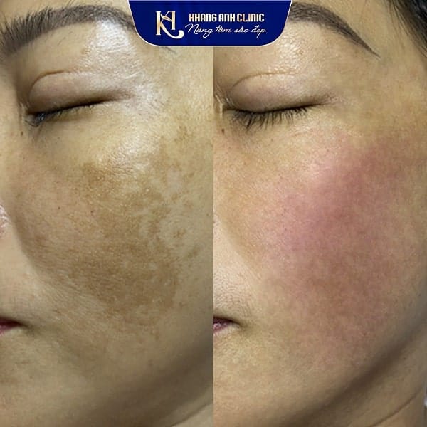 Da mặt khách A trước và sau điều trị nám mảng