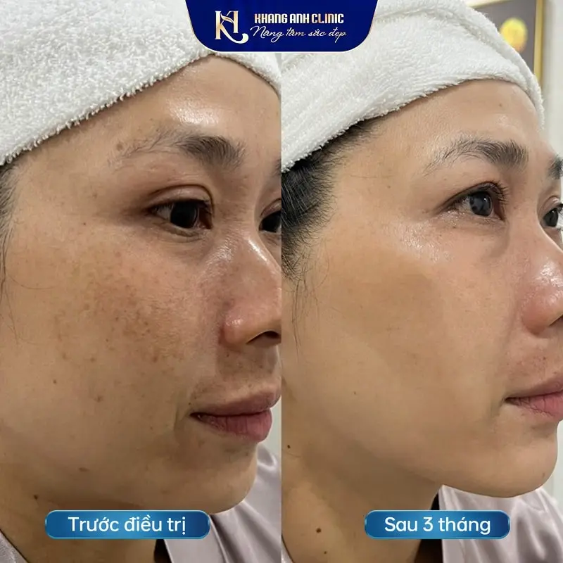 Hình khách a trước và sau trị nám chân sâu