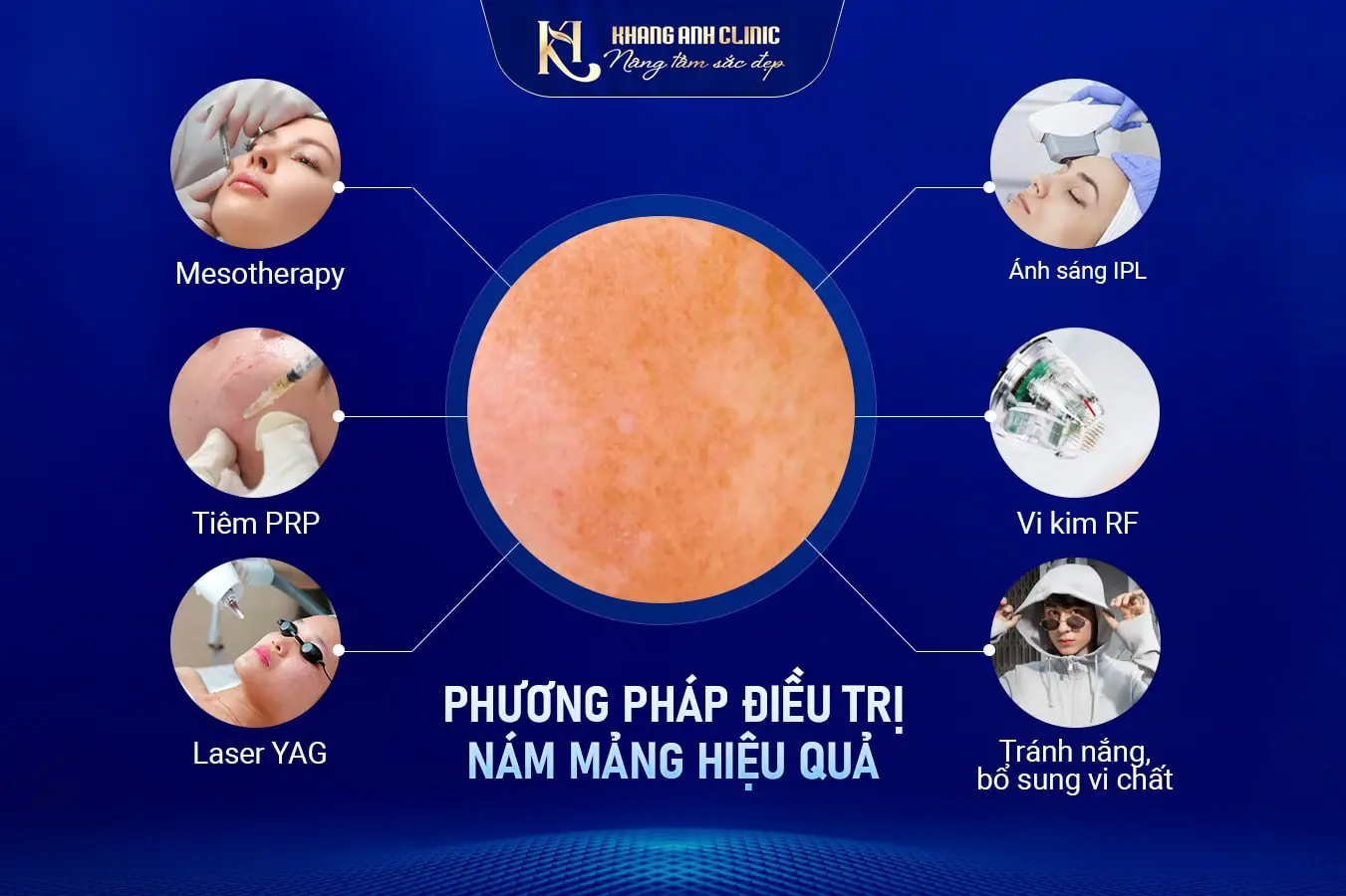 Các phương pháp trị nám mảng
