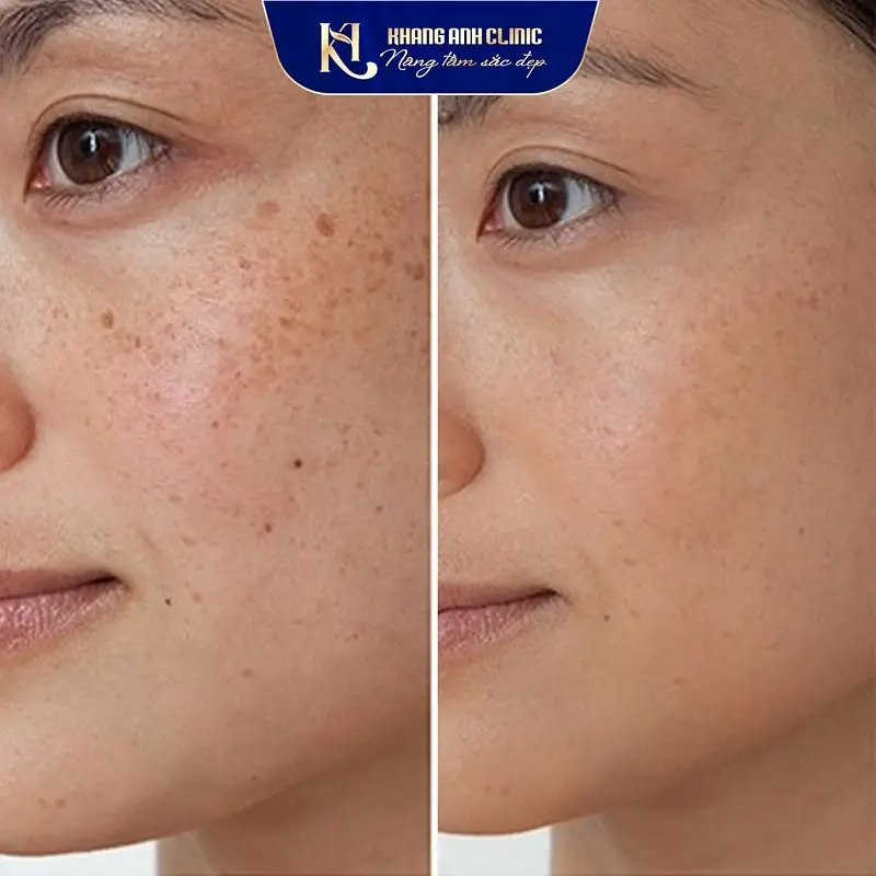 Khách a trước và sau trị tàn nhamg