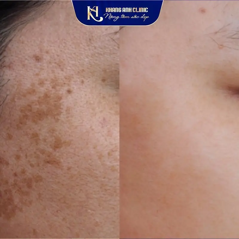 Khách b trước và sau trị tàn nhang
