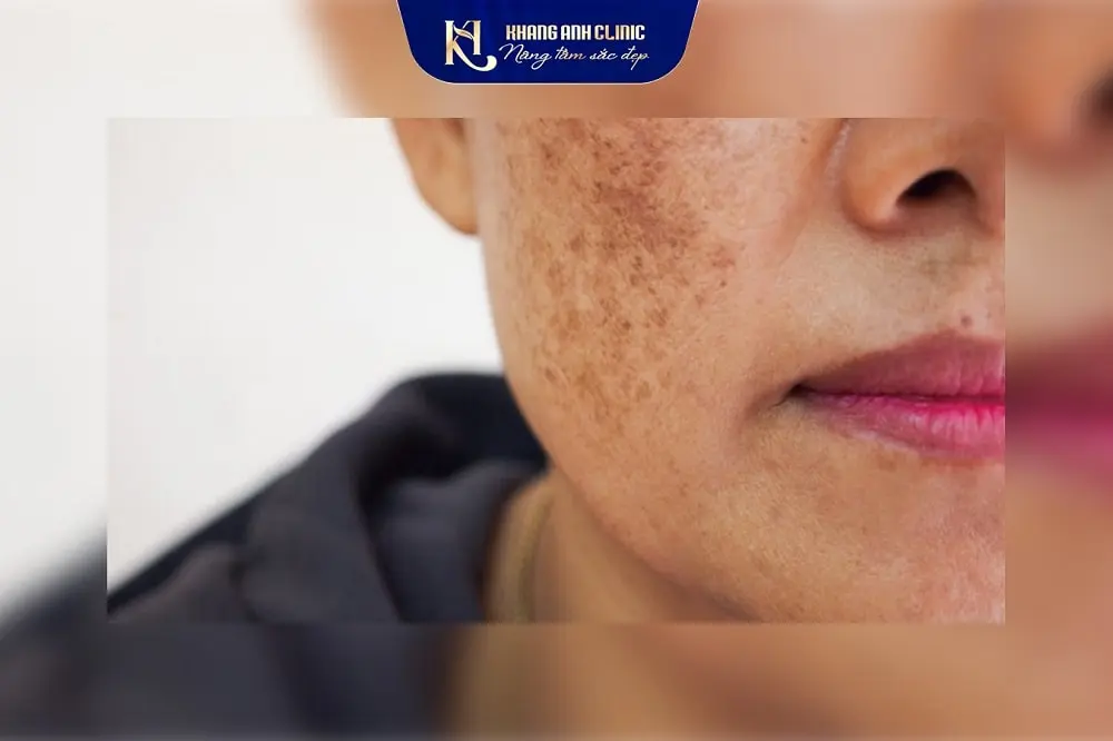 Da bị nám hỗn hợp