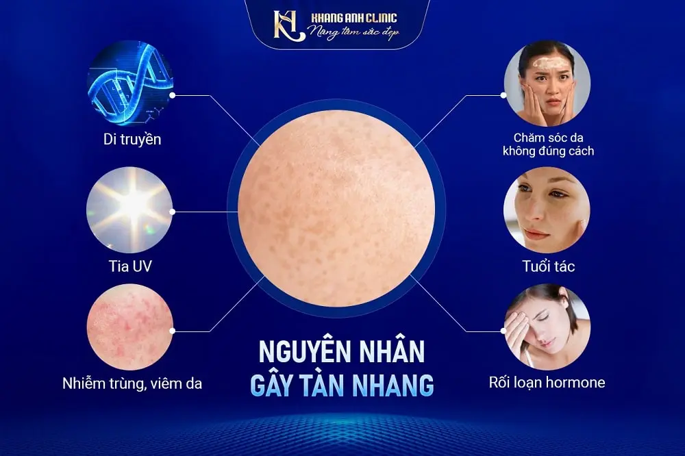 Nguyên nhân gây tàn nhang
