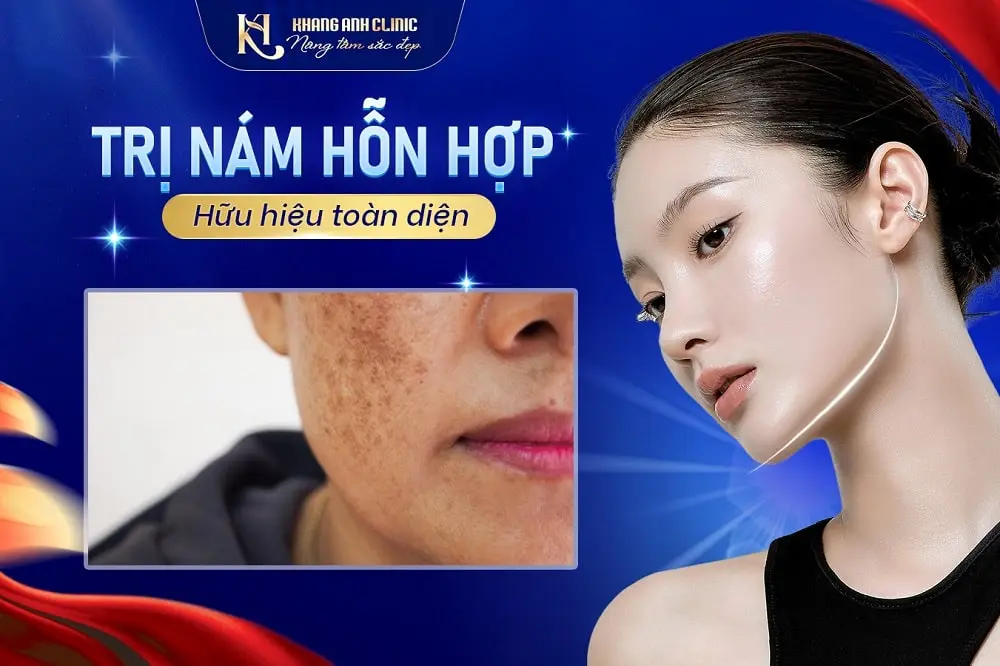 Trị nám hỗn hợp hữu hiệu toàn diện