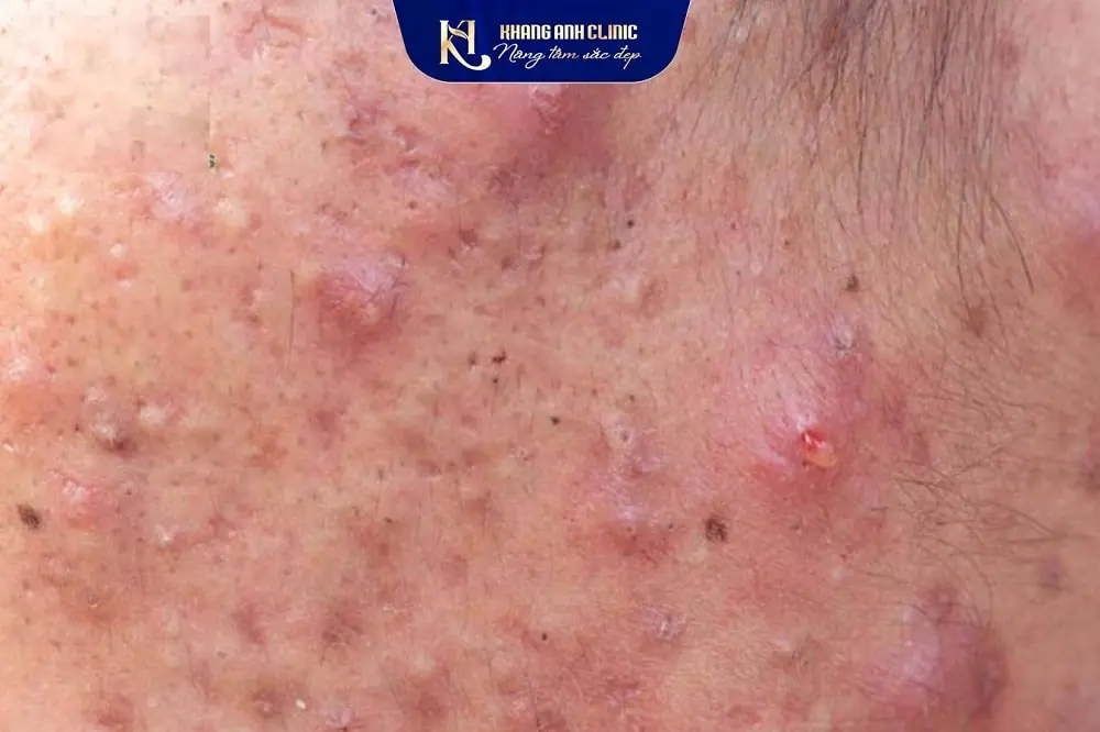 Da mặt bị mụn nang