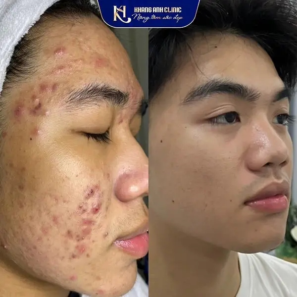 Khách số 2 trước và sau khi trị mụn nang tại Khang Anh