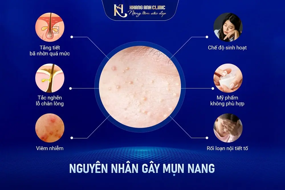 Nguyên nhân gây mụn nang