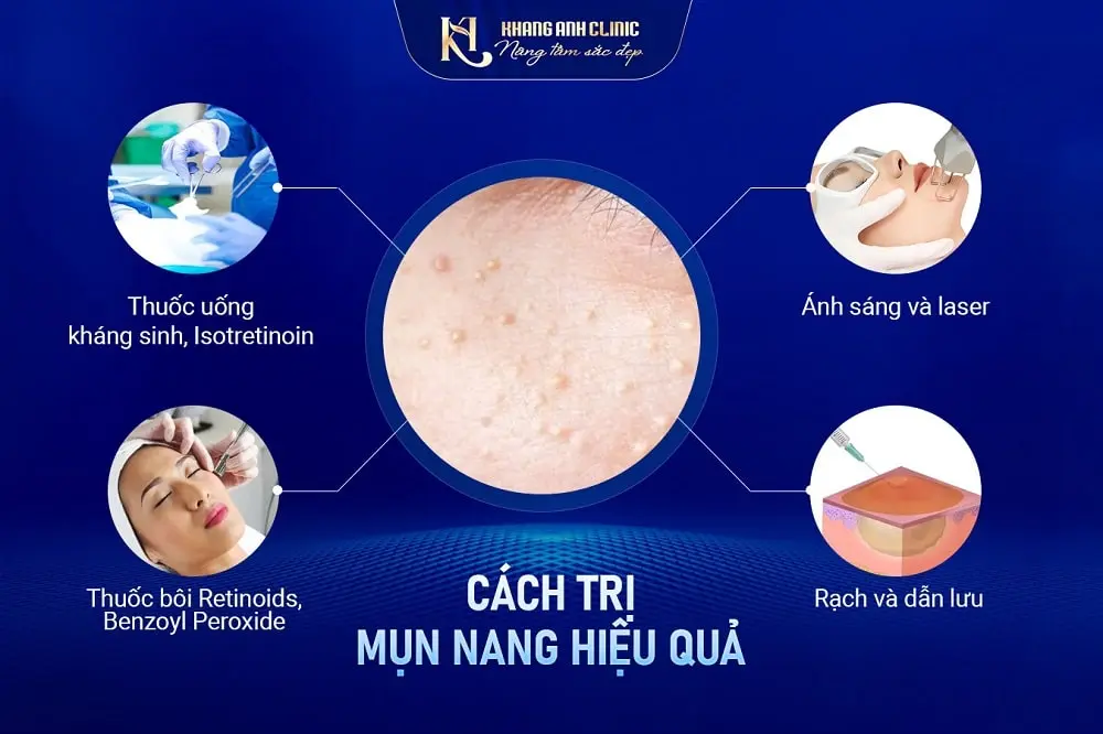 Cách trị mụn nang hiệu quả