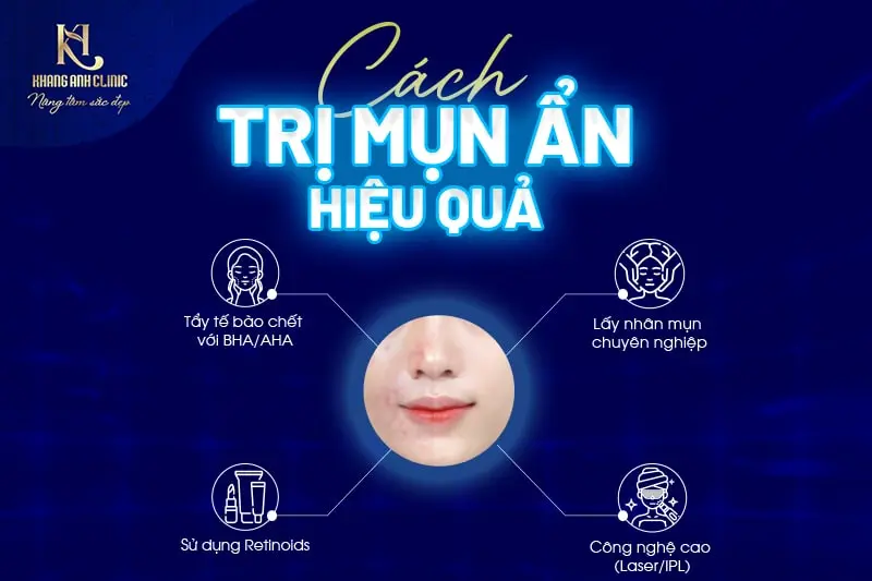 Một số cách điều trị mụn hiệu quả tại nhà