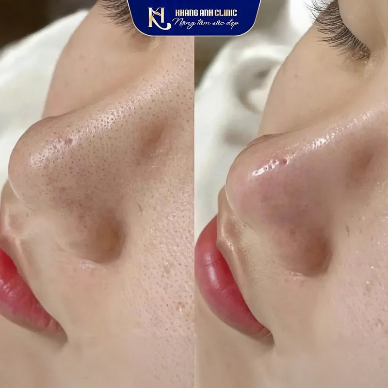 Khách số 2 trước và sau khi trị mụn đầu đen tại Khang Anh
