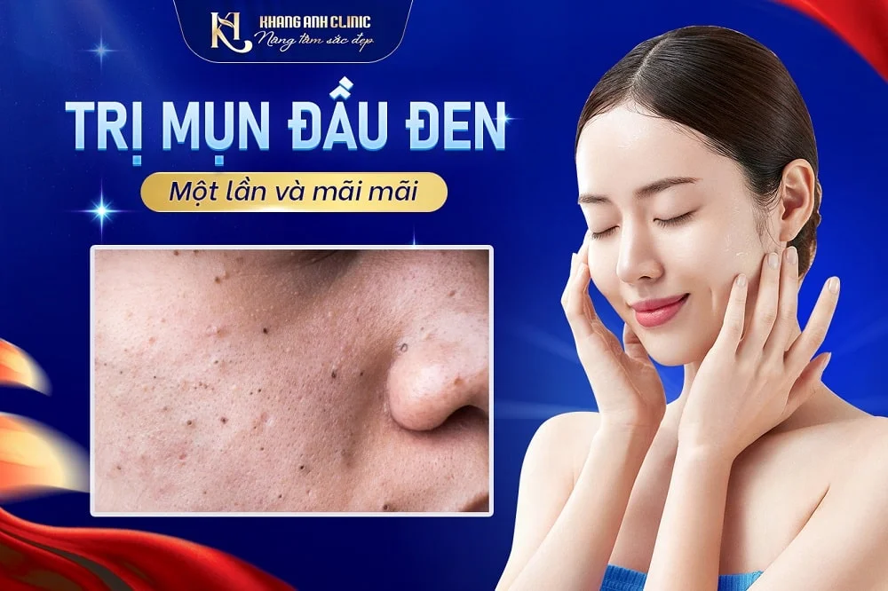 Trị mụn đầu đen hiệu quả tại Khang Anh