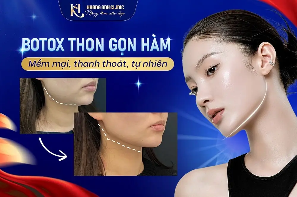 Dịch vụ botox thon gọn hàm
