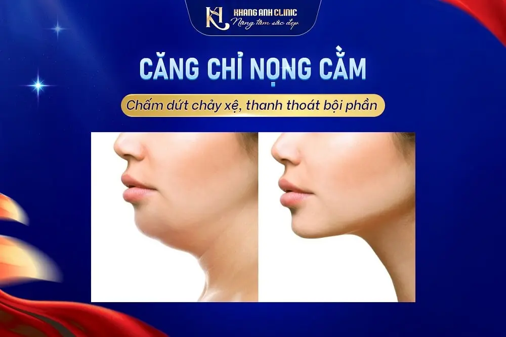 Hiệu quả dịch vụ căng chỉ nọng cằm tại Khang Anh