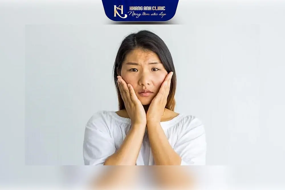 Mặt cần căng chỉ nọng cằm