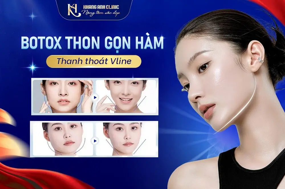 Hiệu quả cấy botox thon gọn hàm