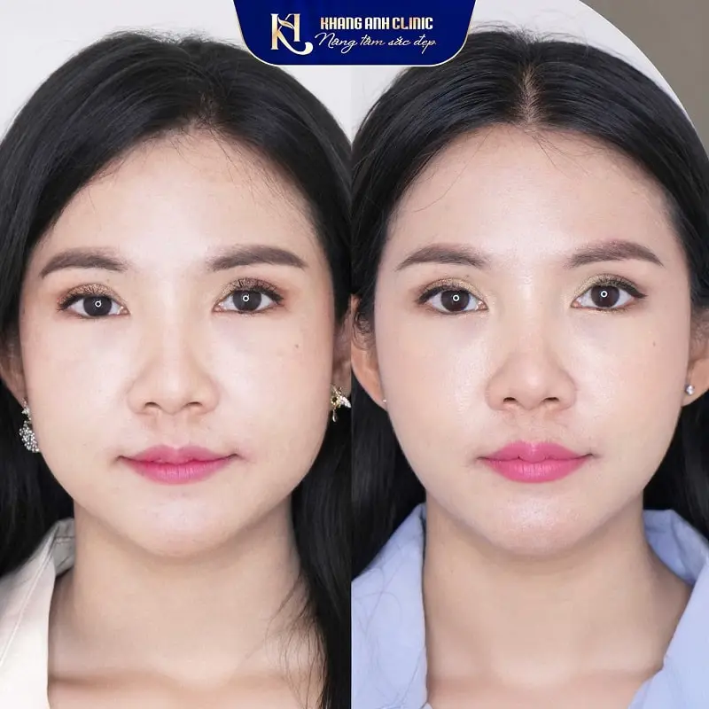 Hình ảnh trước sau của khách số 1 sau khi sử dụng dịch vụ Botox thon gọn hàm