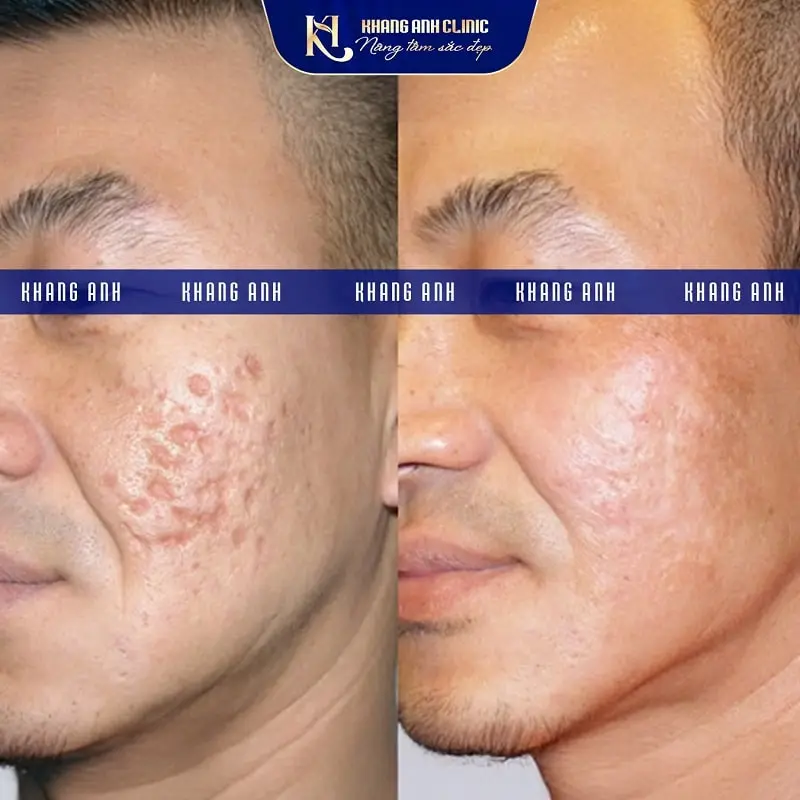 Khách số 1 trước và sau khi điều trị sẹo rỗ tại Phòng khám Da Liễu Thẩm my Khang Anh