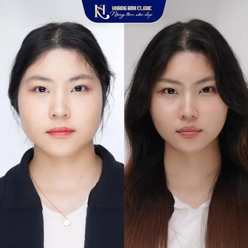 Hình ảnh trước sau của khách số 2 sau khi sử dụng dịch vụ Botox thon gọn hàm tại Khang Anh Clinic