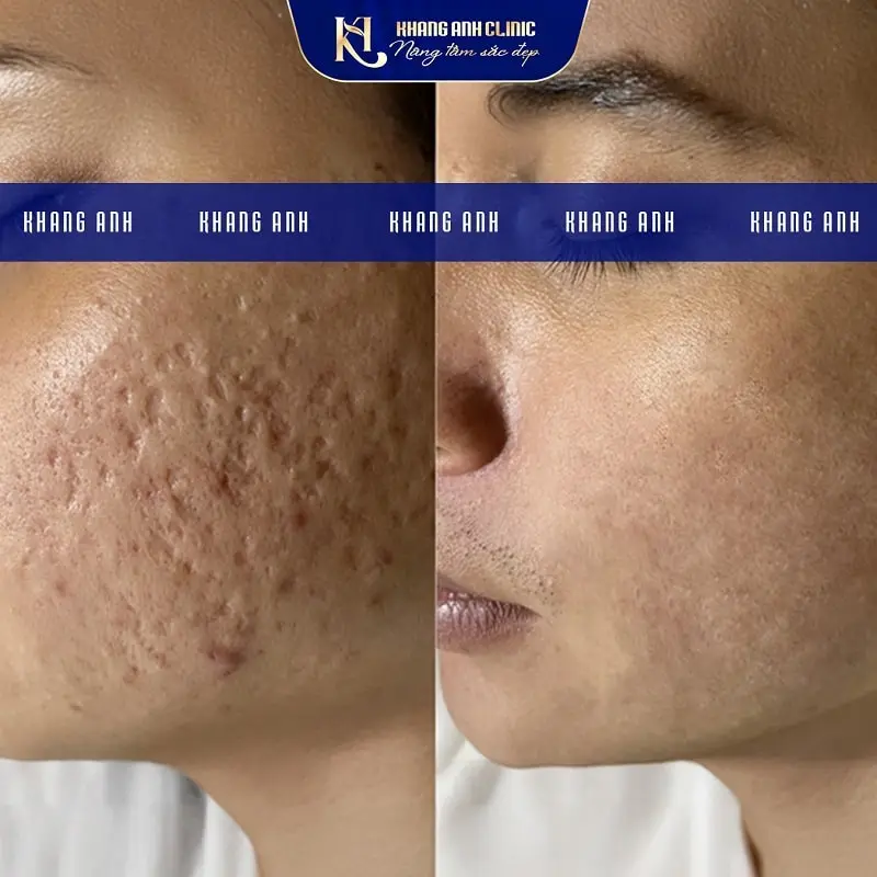 Khách số 2 trước và sau khi điều trị sẹo rỗ tại Phòng khám Da Liễu Thẩm my Khang Anh