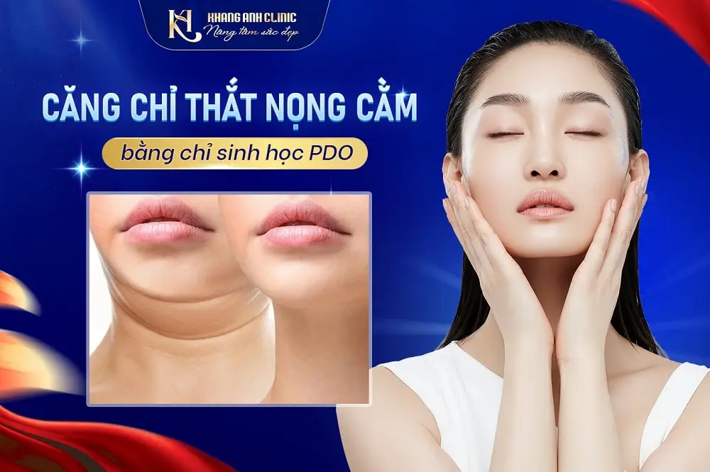 Phương pháp căng chỉ nọng cằm