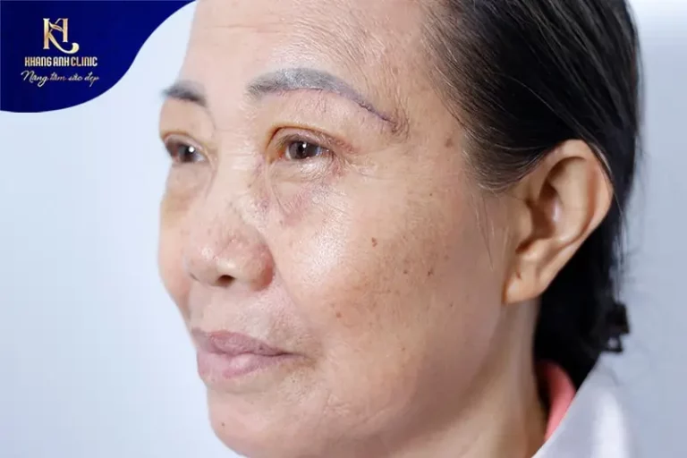 Nâng cung chân mày mini