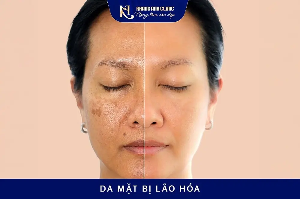 Da mặt bị lão hóa phù hợp để cấy PRP