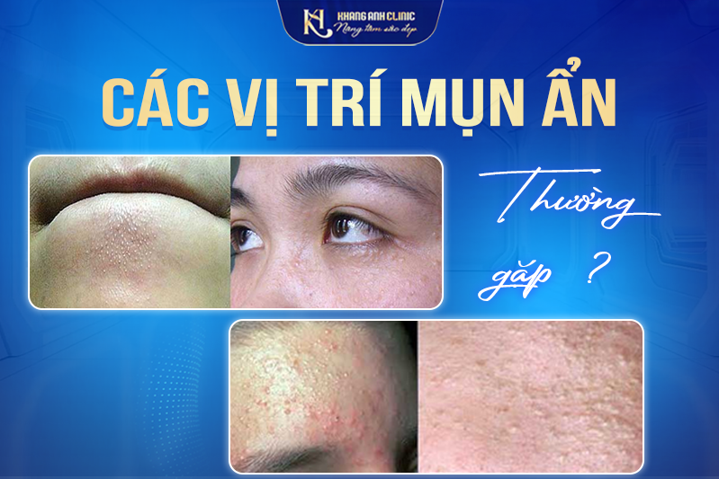 Các vị trí mụn ẩn thường gặp nhất