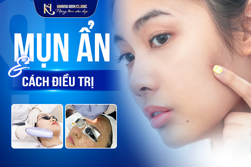 Điều trị mụn ẩn hiệu quả – Giải pháp da liễu an toàn