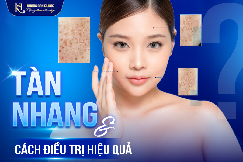 Cách điều trị Tàn Nhang hiệu quả tại Khang Anh