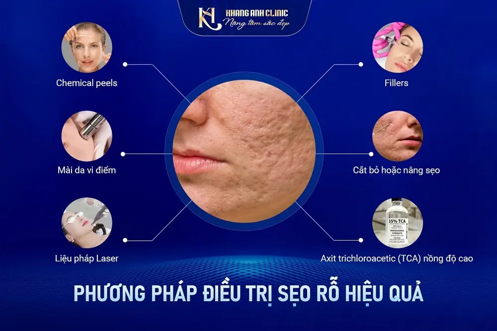 Cách trị sẹo rỗ