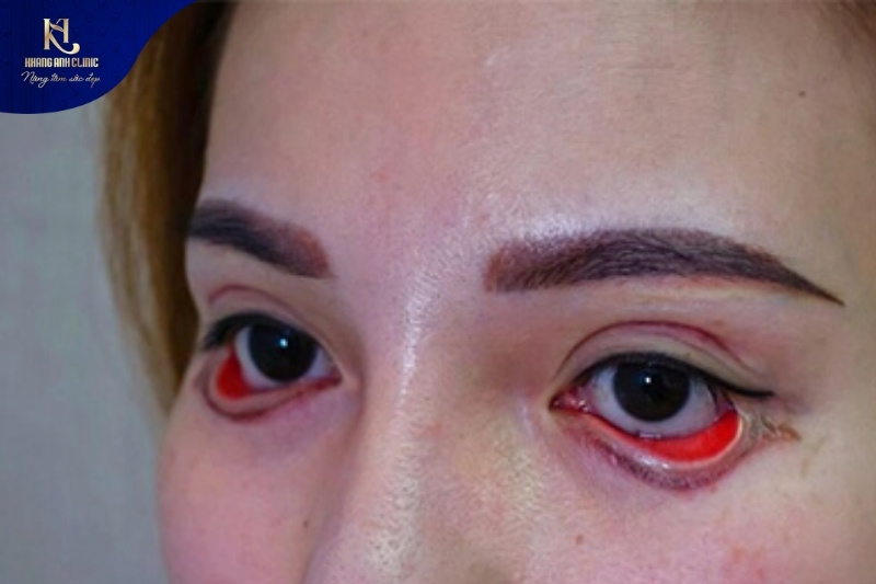 Mắt mí dưới bị lỗi sau cắt cần chỉnh lại