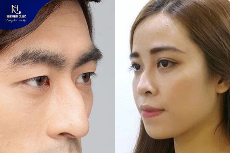 Mũi gồ là dạng mũi có phần xương sống cong, tạo thành gồ trên mũi