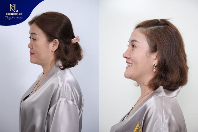 Sau chỉnh hình mũi gồ cần khoảng 6-1 năm để có thể phục hồi hoàn toàn