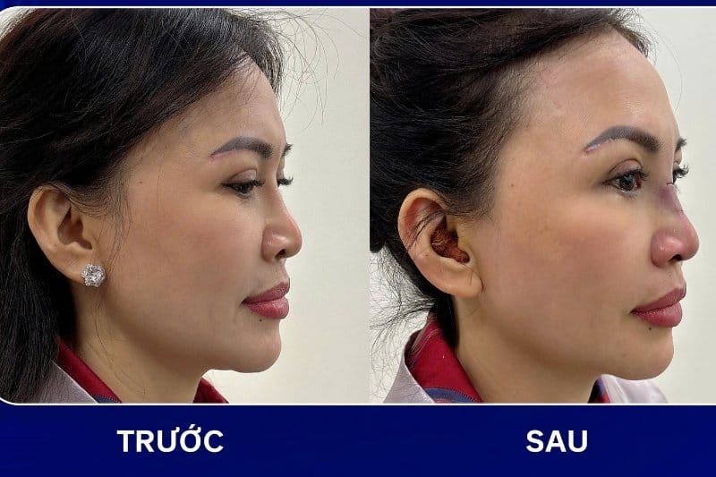 Kết quả trước và sau chỉnh hình mũi gồ tại Khang Anh