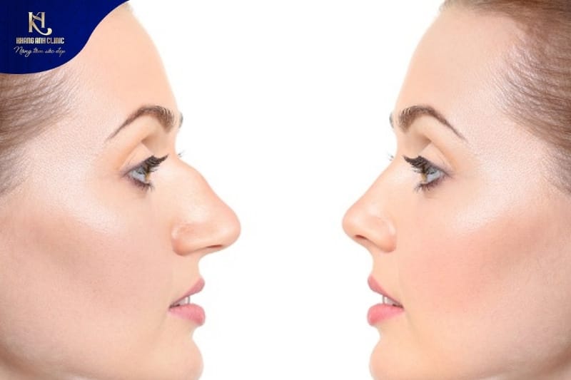 Dáng mũi gồ do nhiều yếu tố từ bẩm sinh, chấn thương và quá trình phát triển