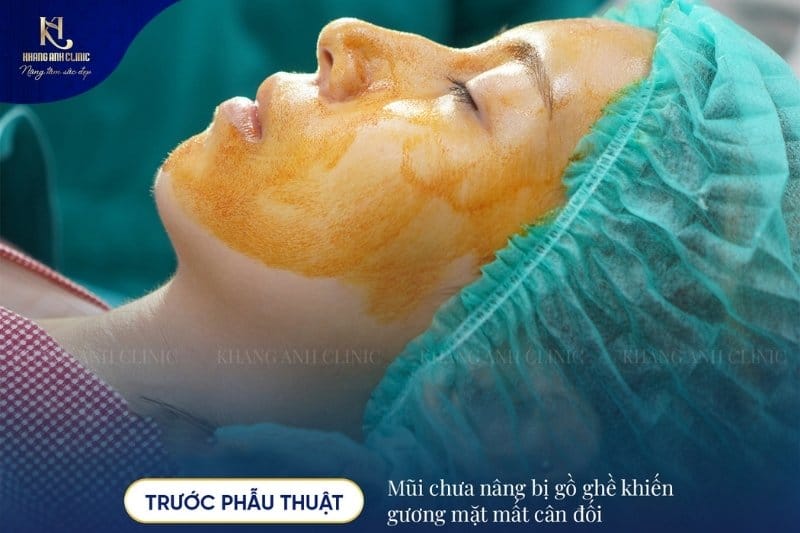 Chỉnh hình mũi gồ giúp bạn tăng sự tự tin và cải thiện thẩm mỹ gương mặt